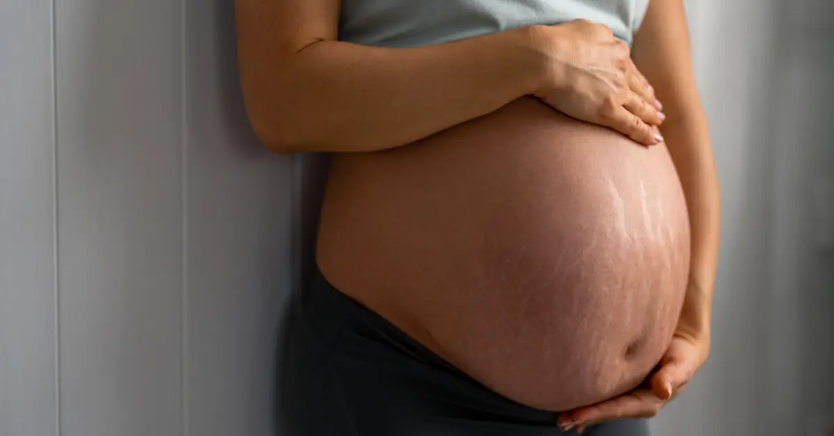 Pregnant belly with stretch marks using Bio Oil