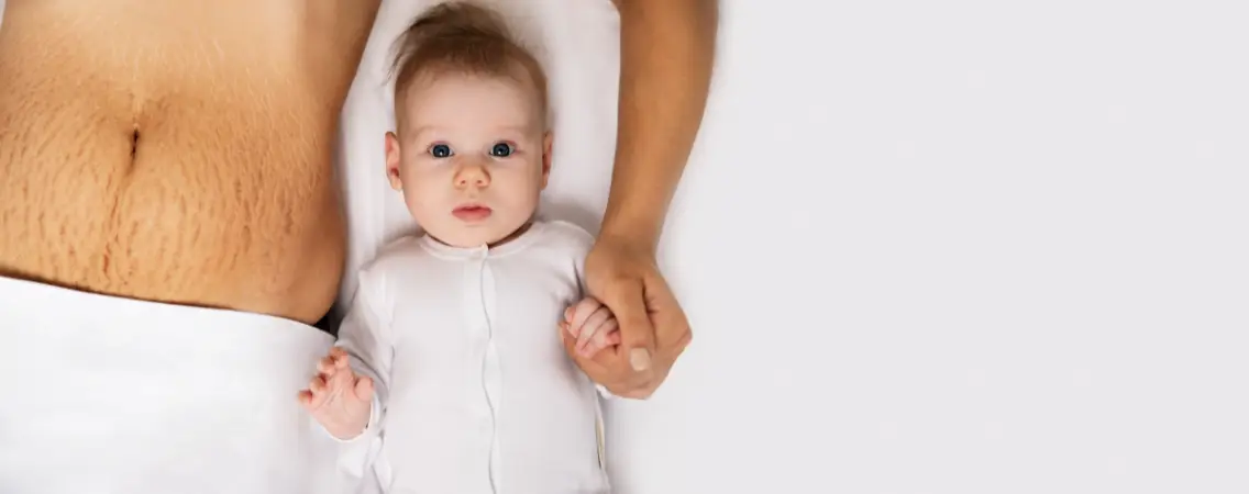 Women with Stretch marks and baby wondering if she should use bio-oil